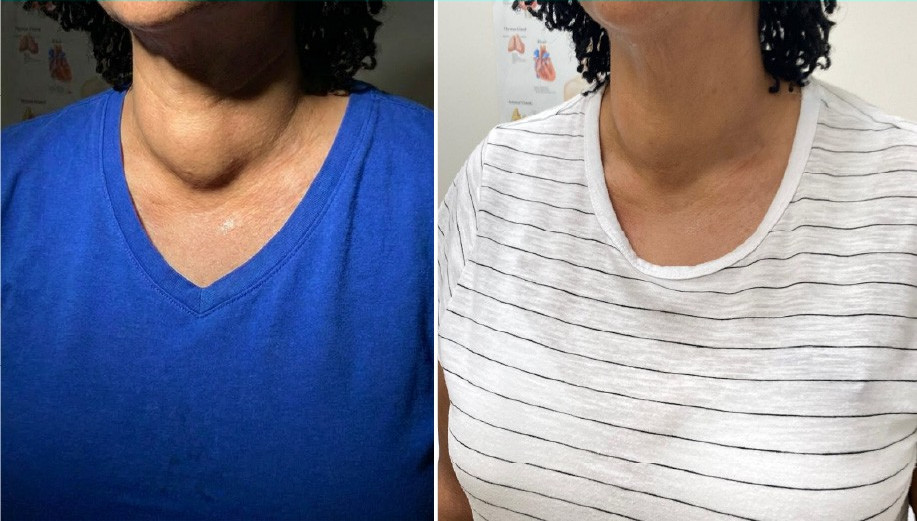 De-identified anterior neck photographs of a patient's neck before and after radiofrequency ablation, showing reduced neck fullness at follow-up.